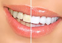 Teeth Whitening: Croft Dental Centre