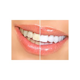 Teeth Whitening: Croft Dental Centre